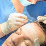 What You Need to Know About Hair Transplant London