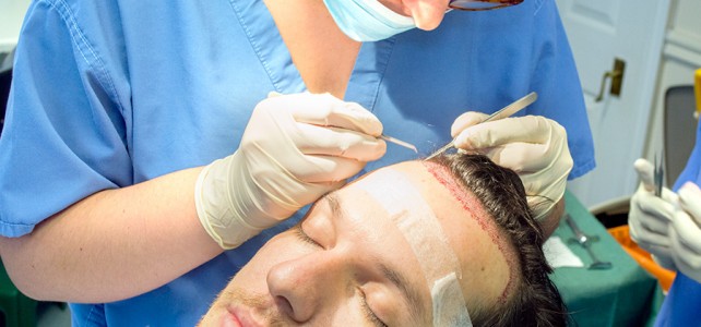 What You Need to Know About Hair Transplant London